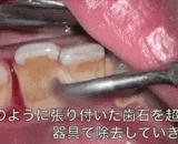 Tooth stones, this is a few decades old.,牙结石，这个怕是几十年的存货了