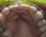 The process of tooth correction, wonderful!,牙齿矫正过程，好神奇！