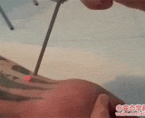 激光纹身移除 - Laser tattoo removal