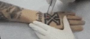 激光去纹身 - Laser tattoos
